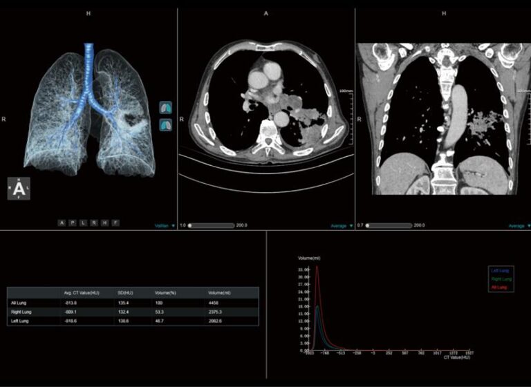 AI Based CT Lung Density Analysis