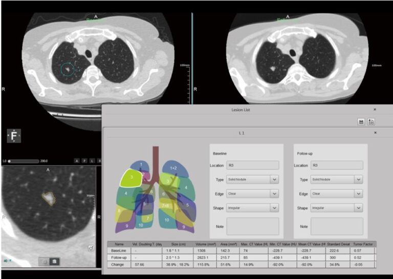 AI Based CT Lung Nodule Analysis