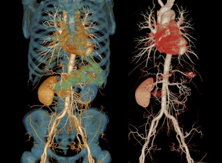 CT Angiography Body