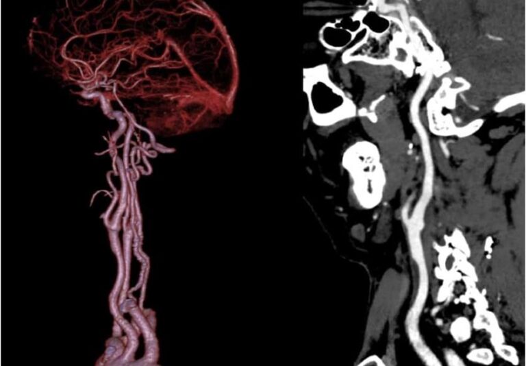 CT Angiography and Vessel Analysis