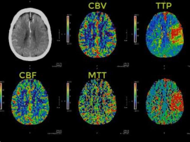 CT Perfusion Brain and Body