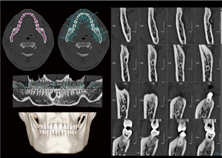 Comprehensive Dental Analysis with Nerve Line Marking