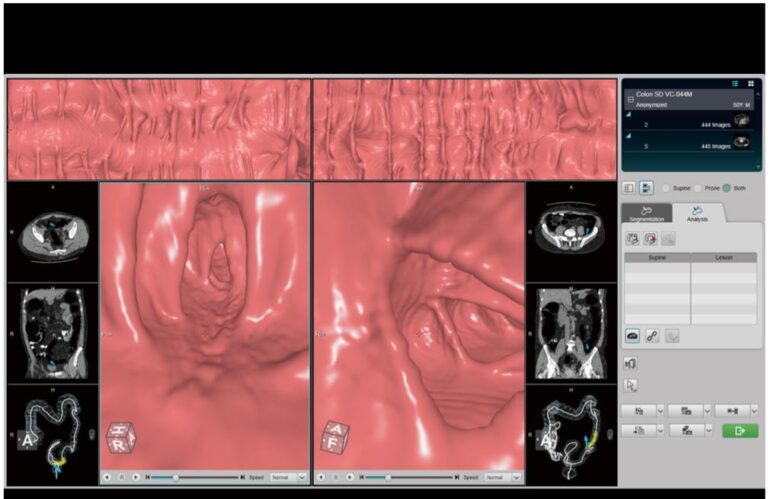 Virtual CT Colonoscopy